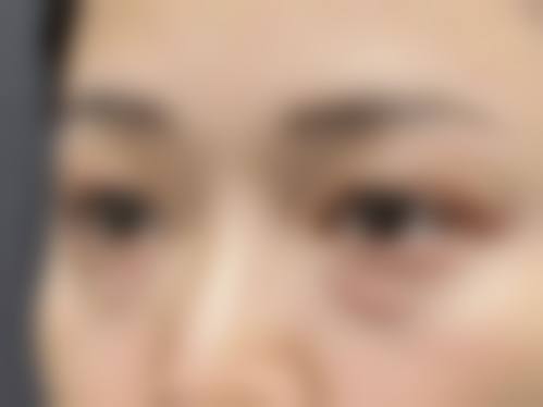 四、天生眼袋去除手术:手术治疗法