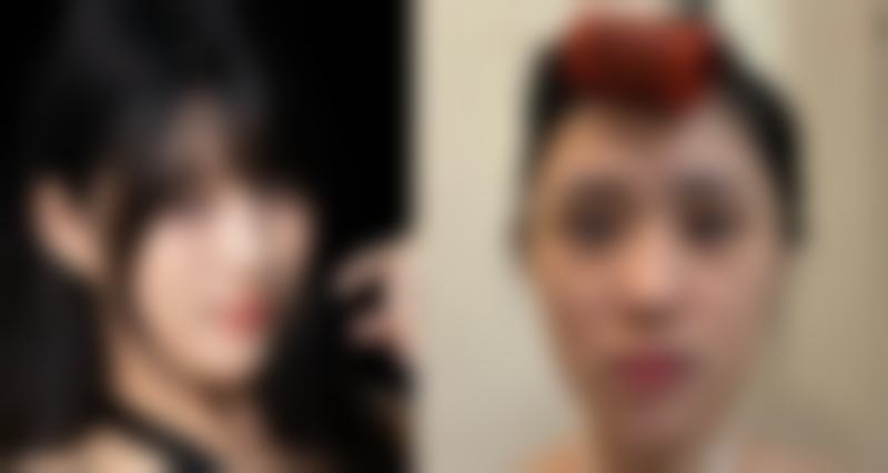 二、如何去除天生眼袋:物理治疗法