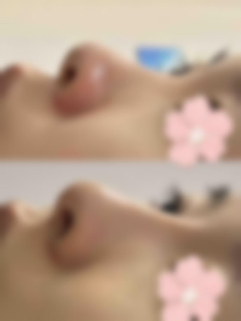 ① 雙眼皮手術真相：韓國真係無痕？