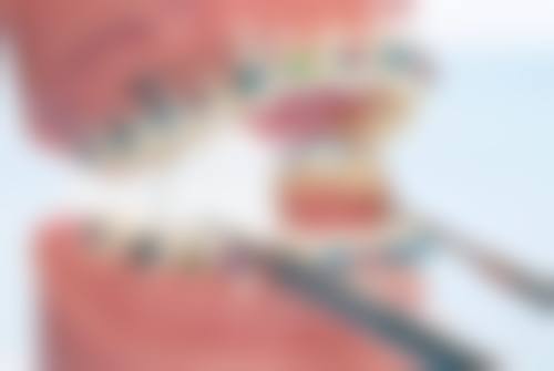 深圳青少年隱適美 適合邊類人群?