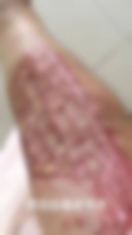 五、开封汴美整形医院真实实例参考