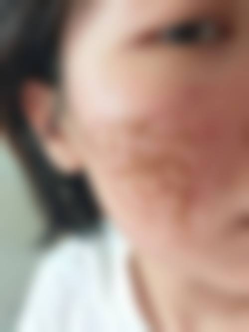二、激光去皱纹有成效吗