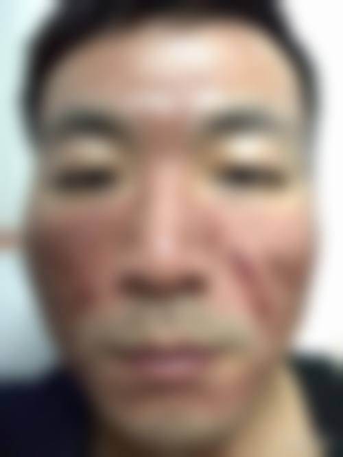 六、激光去皱的安心性及可能的副作用