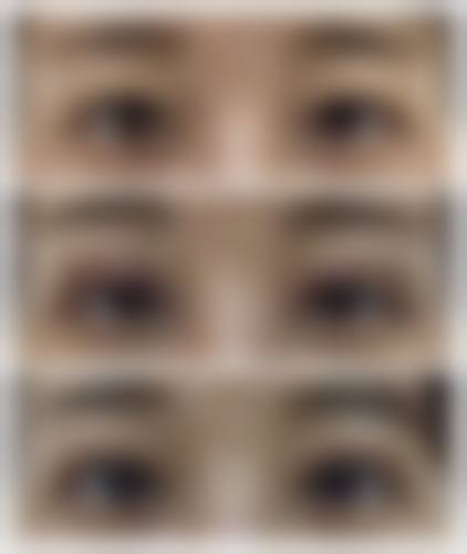 二、影响割双眼皮留疤的因素