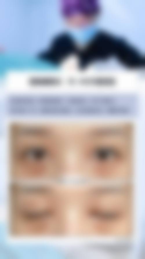 四、割双眼皮留疤后的处理方法