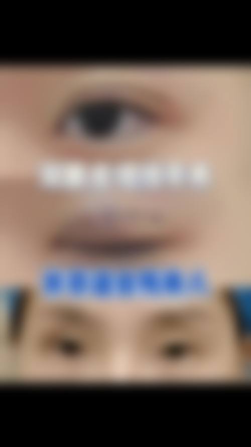十、割双眼皮的后遗症