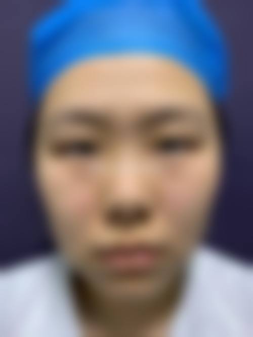 二、全切双眼皮术后修复时间