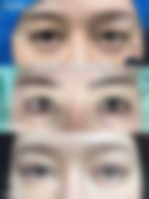 四、全切双眼皮成效如何