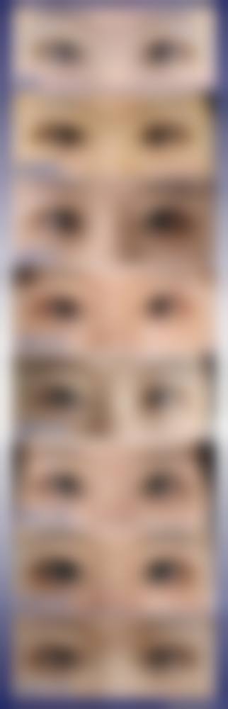三、全切双眼皮术后科学护理要点