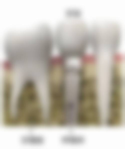 植牙項目真相:香港姊妹更常問嘅3個問題