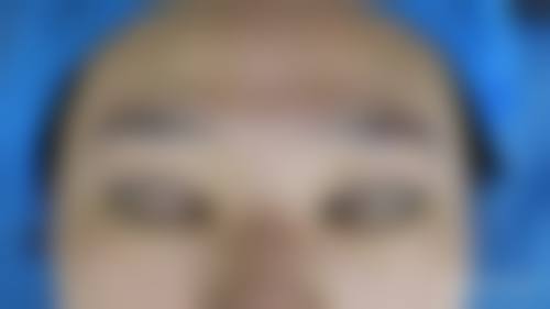 七、怎么判断自己是否适合全切双眼皮