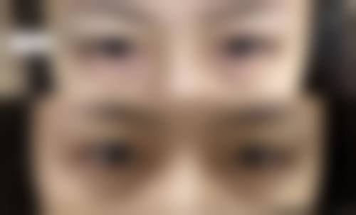 韓國TS術後恢復快嗎 適合邊類人群?