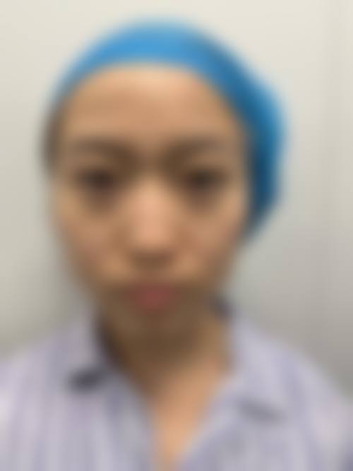 韓國GNG鼻整形好唔好？2026無假體隆鼻+高難鼻修復！權威醫生+費用一覽