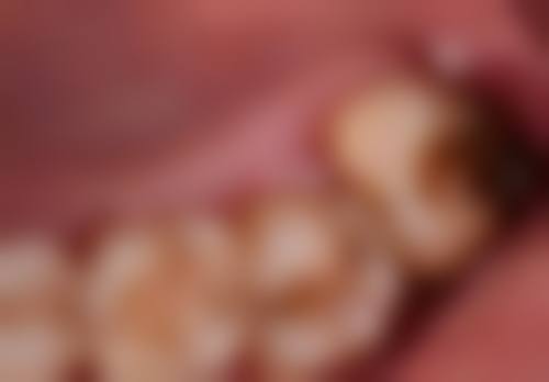 深圳老人家種牙術前術後避坑指南