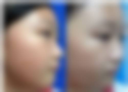 二、全切双眼皮涂抹祛疤膏多久见效