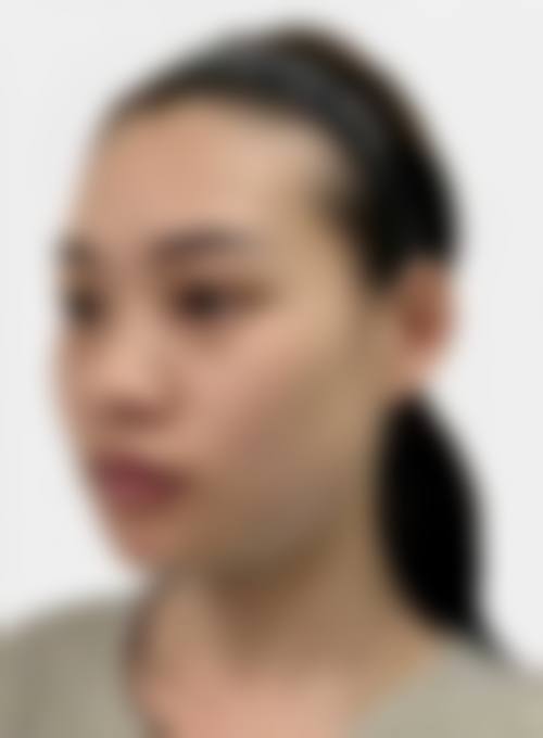 四、玻尿酸适合什么肤质