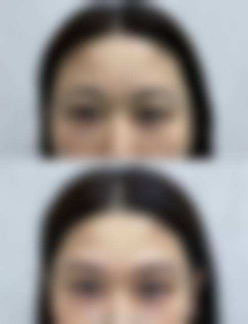 二、颖采玻尿酸属于什么档次