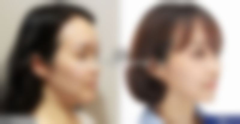 韓國輪廓手術值唔值得做 關鍵選擇點(附香港/澳門查詢方法)
