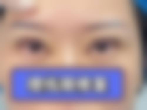 三、韩式三点双眼皮拆线后多久能化妆